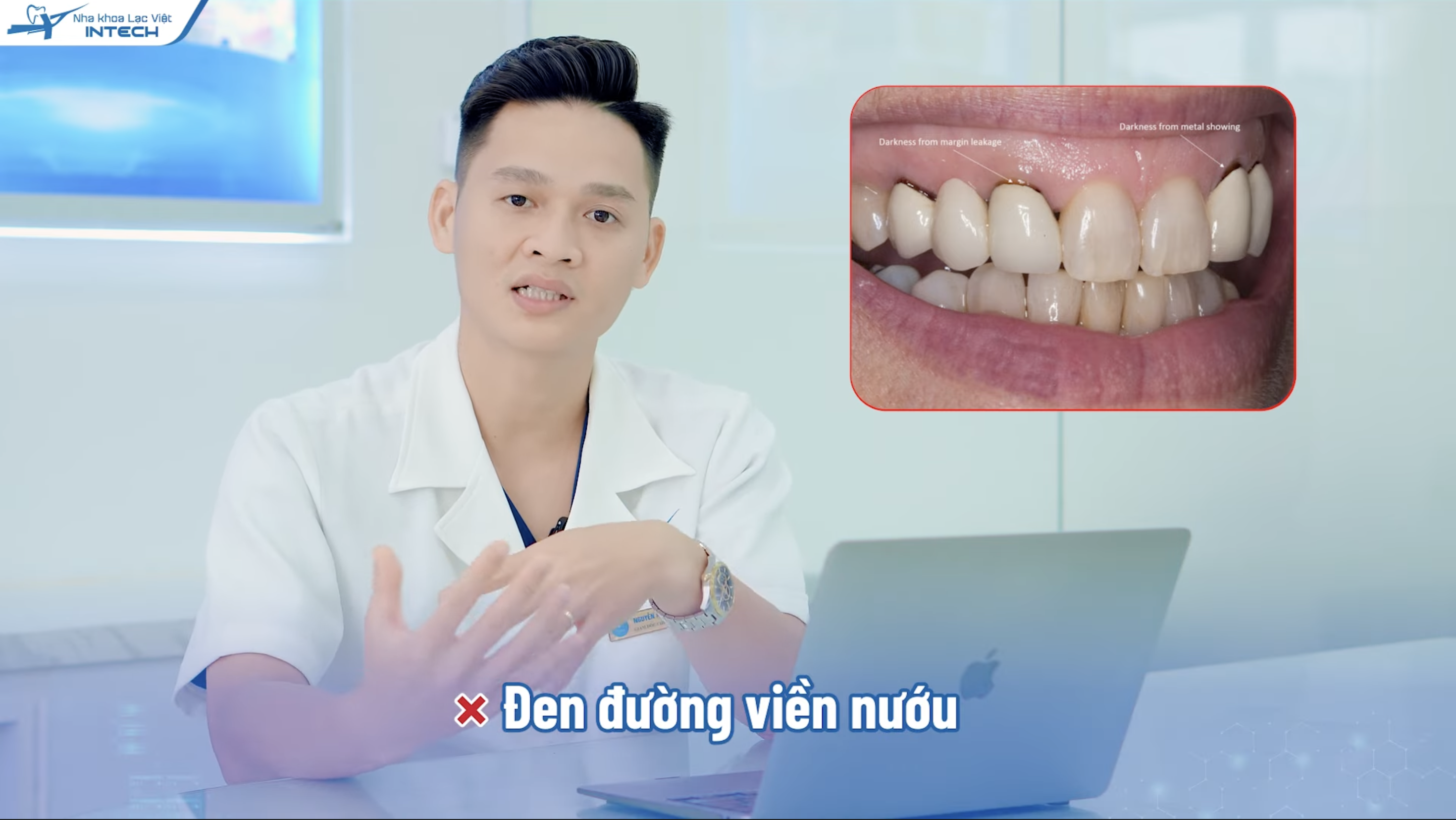 Sử dụng răng sứ kim loại có thể bị đen đường viền nướu ở chân răng khiến răng sứ mất đi vẻ đẹp tự nhiên