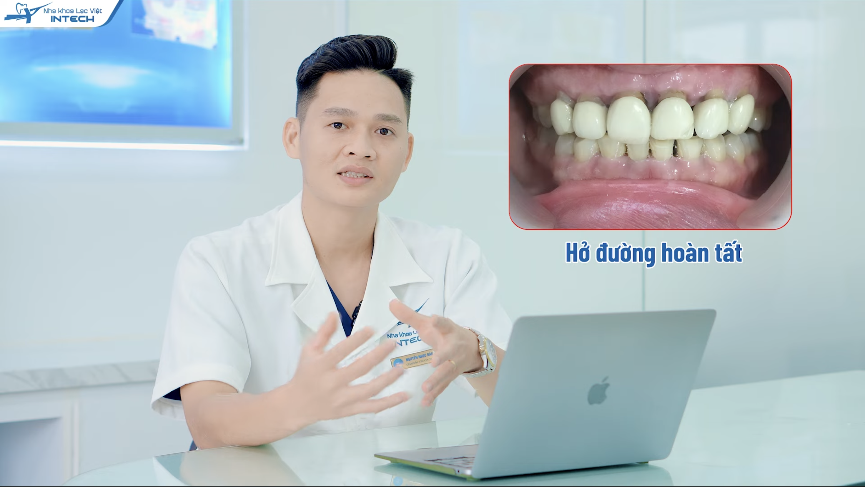 Đường viền nướu có thể bị hở nếu kỹ thuật gắn sai 