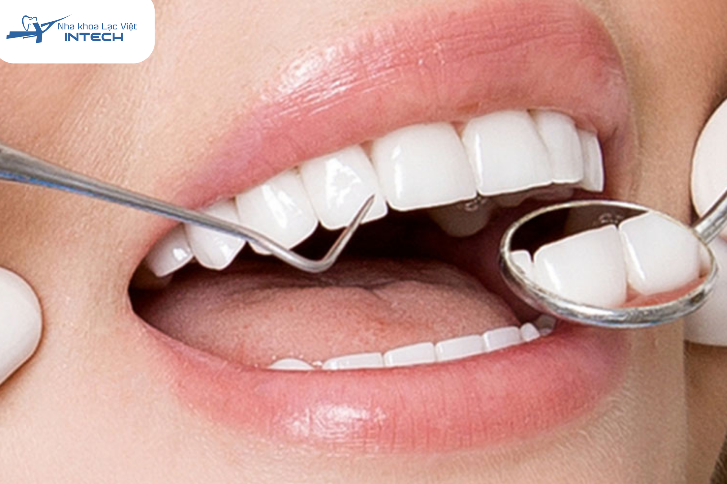 Răng sứ được ưa chuộng vì cải thiện thẩm mỹ rõ rệt