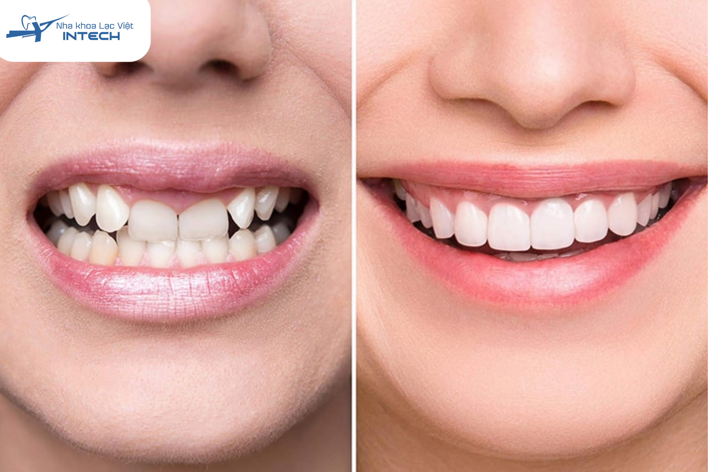Bọc răng sứ là phương pháp phục hình giúp che đi các khuyết điểm và cải thiện chức năng ăn nhai