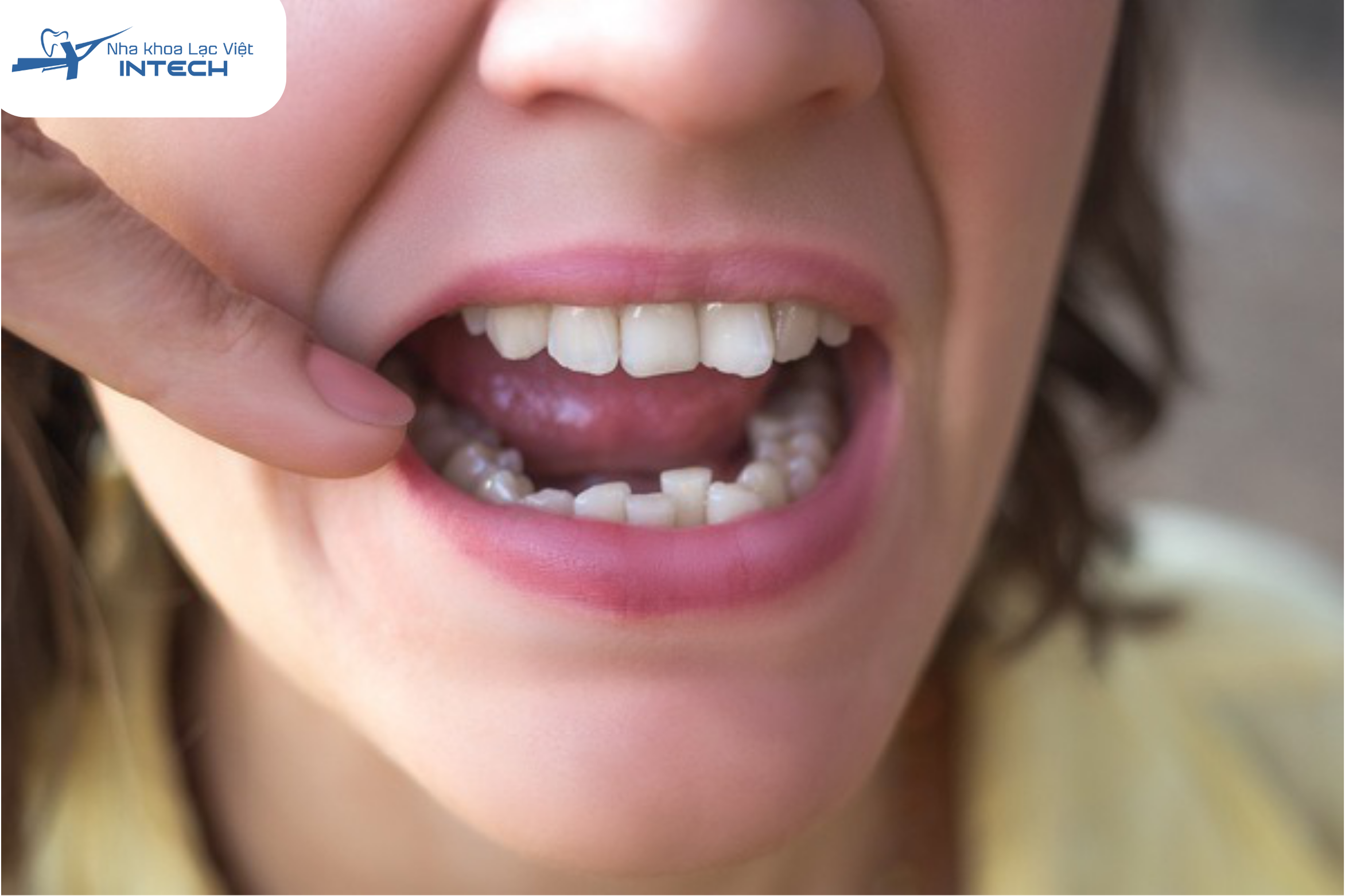 Răng khấp khiểng không đều nên bọc sứ để điều chỉnh hình dáng răng
