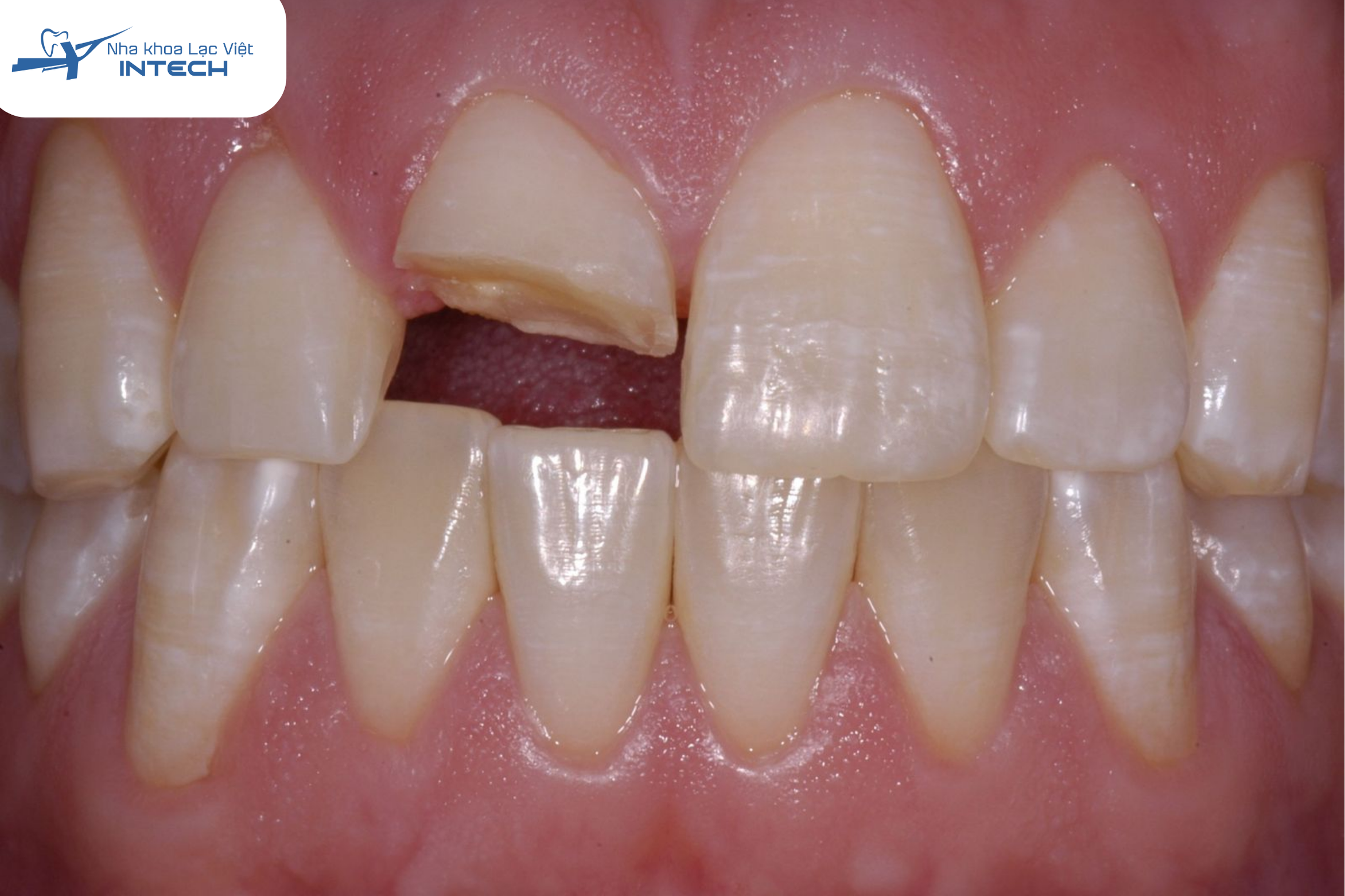 Răng bị sứt mẻ nên làm răng sứ để phục hình thẩm mỹ