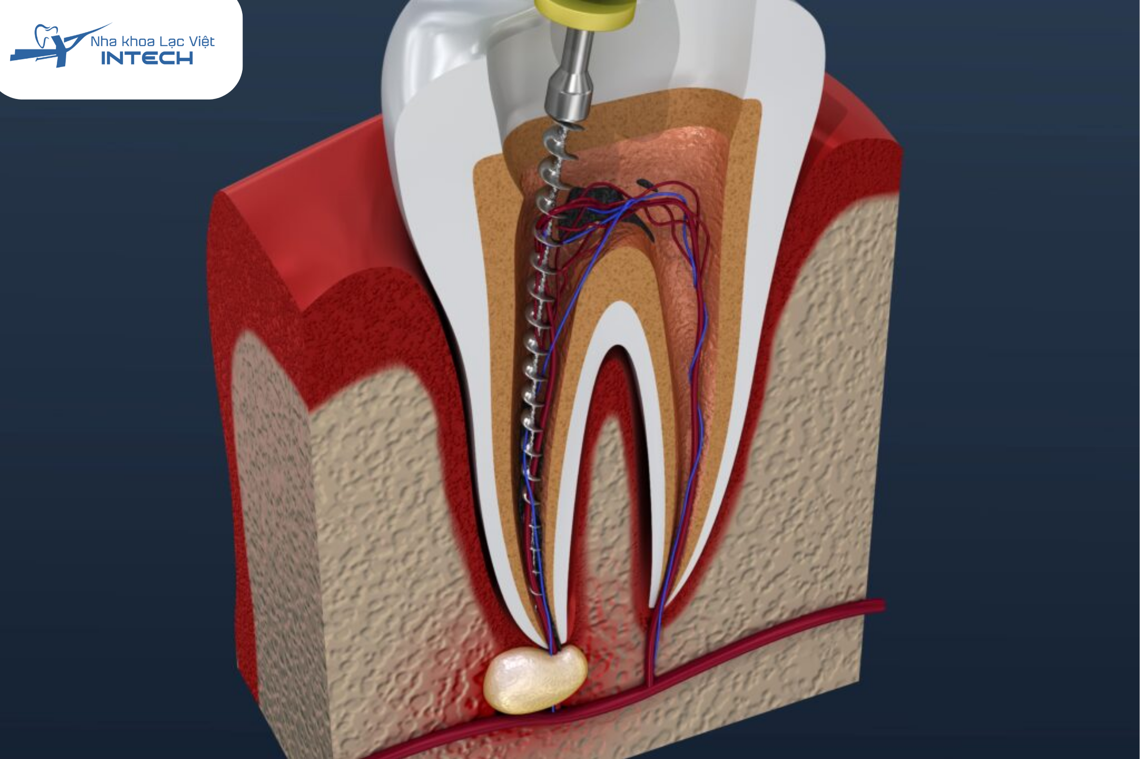 Điều trị tuỷ răng giúp bảo tồn răng thật tối đa, khôi phục chức năng ăn nhai