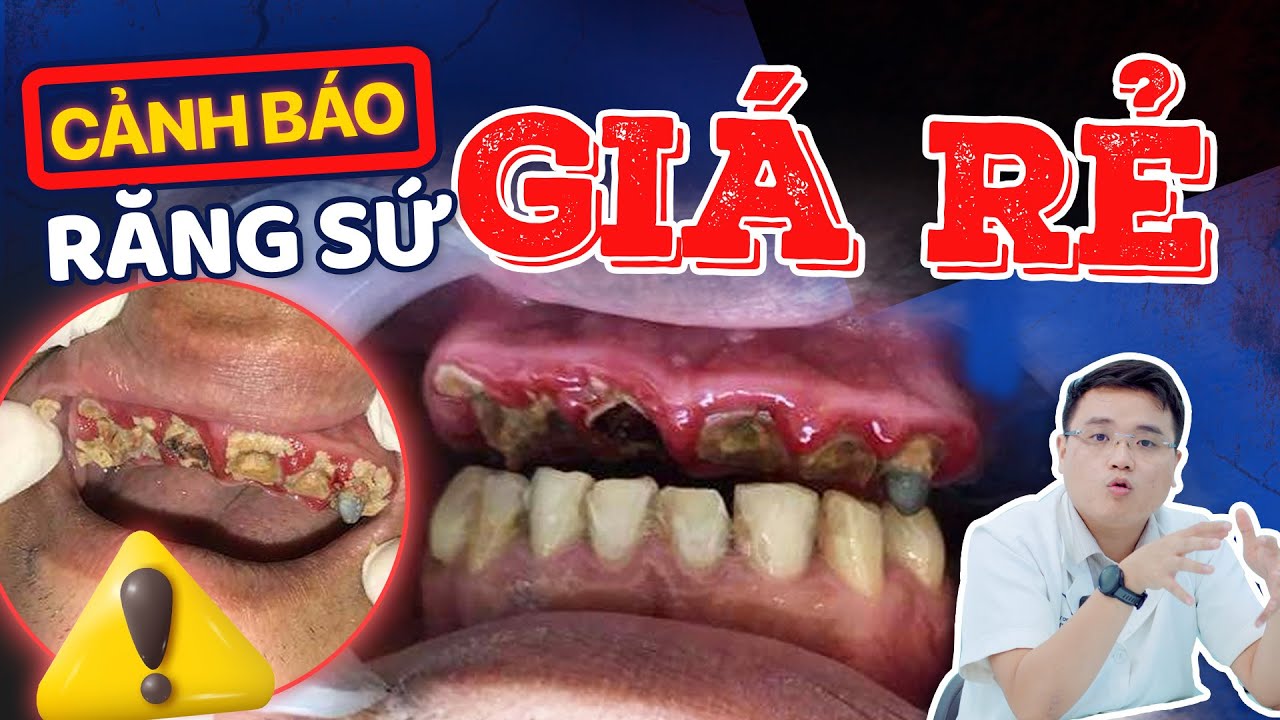 Bọc răng sứ giá rẻ: Sự thật đằng sau mức giá “khó tin”