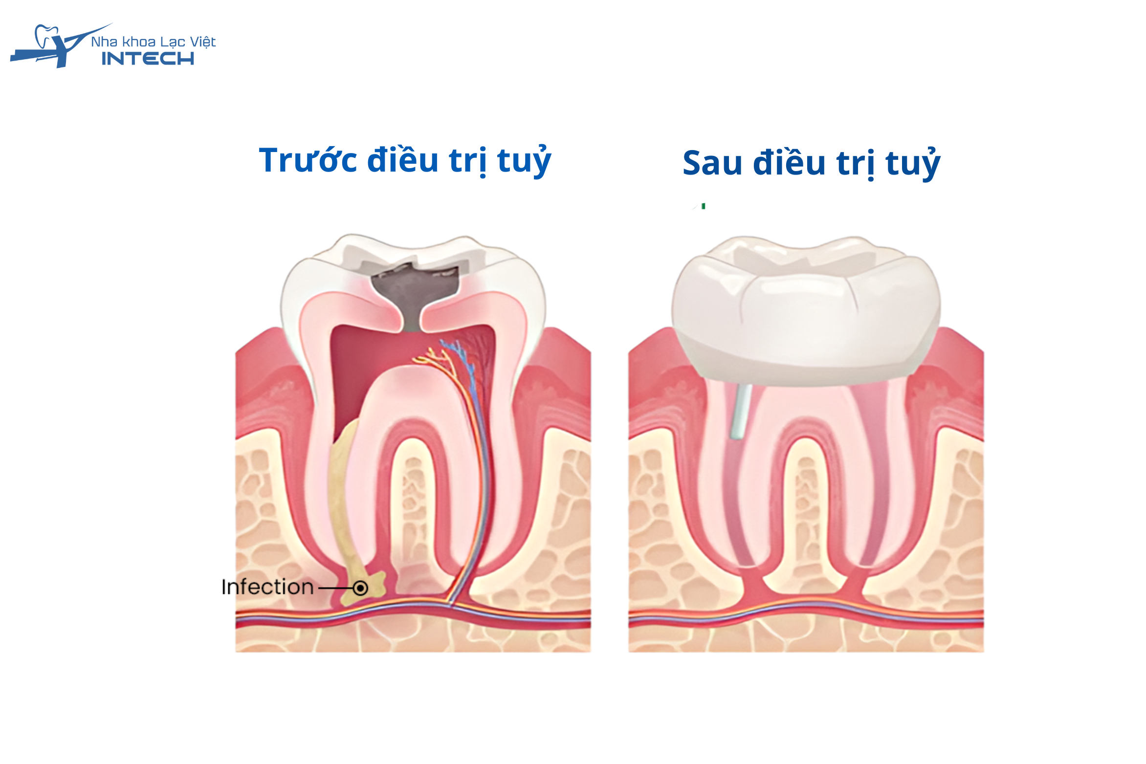 Tuổi thọ của răng điều trị tuỷ không chỉ phụ thuộc vào phương pháp phục hình, mà còn chịu ảnh hưởng bởi tay nghề bác sĩ, chất lượng vật liệu sử dụng