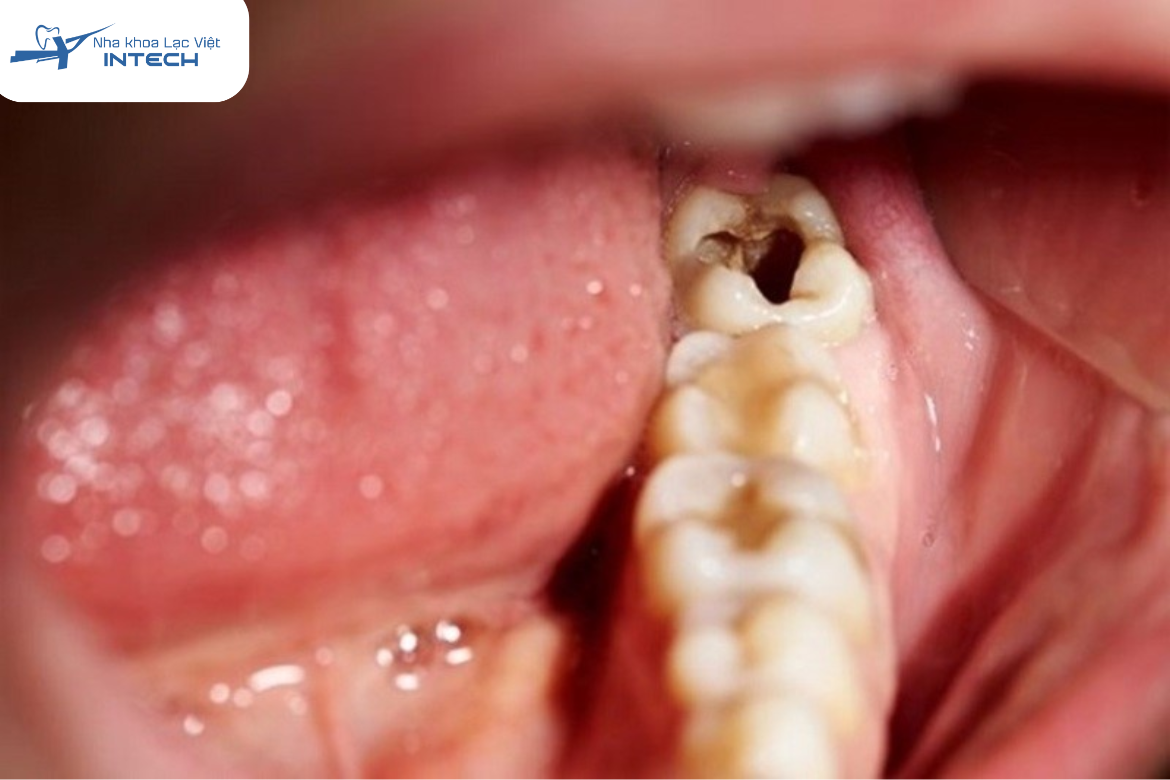 Răng sâu vỡ lớn nên điều trị tuỷ răng để bảo vệ răng thật
