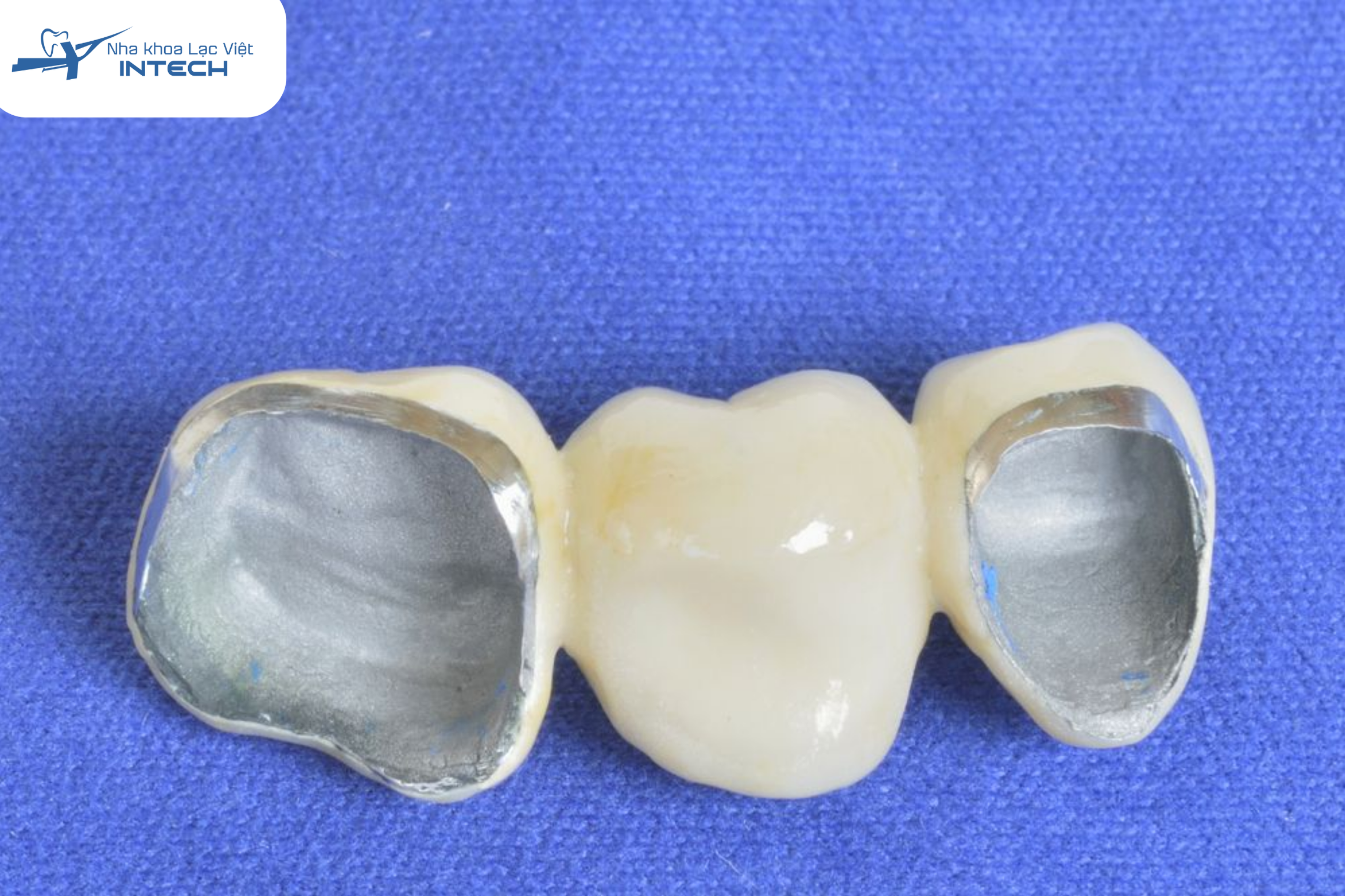 Răng sứ kim loại có chi phí tương đối thấp và bền nhưng tính thẩm mỹ không cao