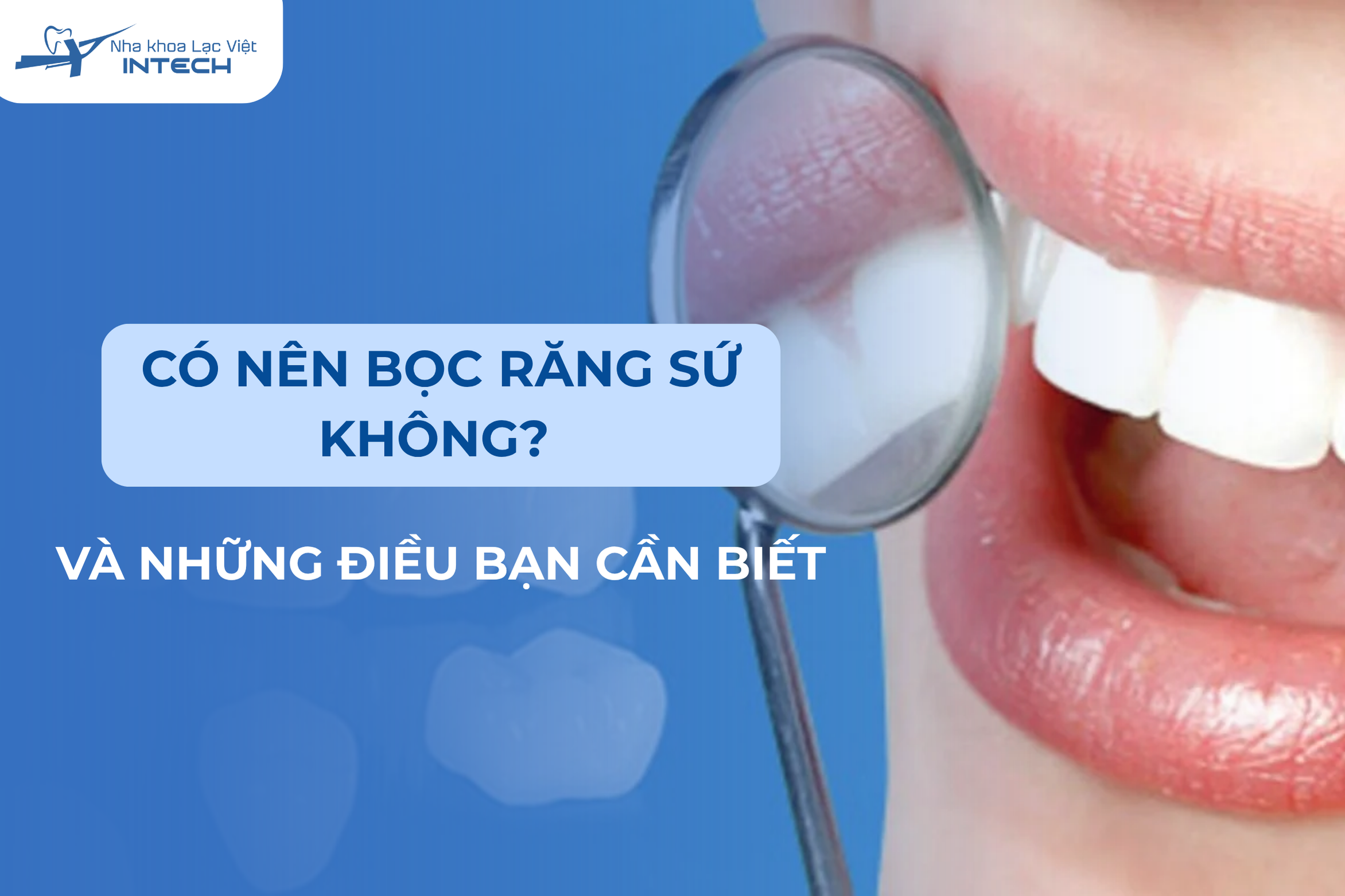 Có nên bọc răng sứ không? 5 điều cần biết trước khi quyết định