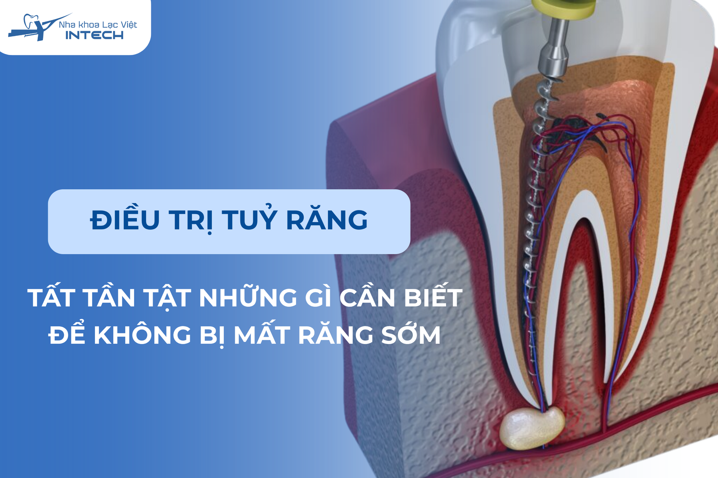 Điều trị tuỷ răng: Tất cả những gì bạn cần biết để không bị mất răng sớm