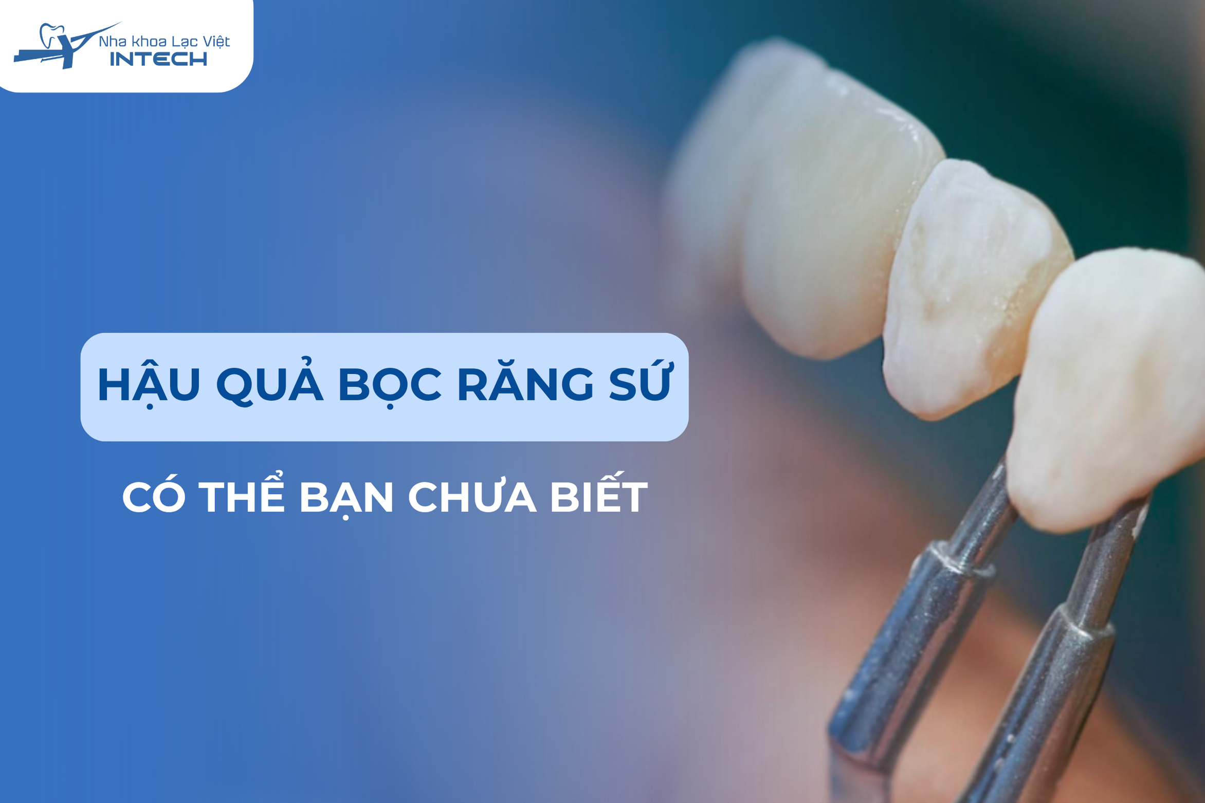 90% người bọc răng sứ không biết những hậu quả này
