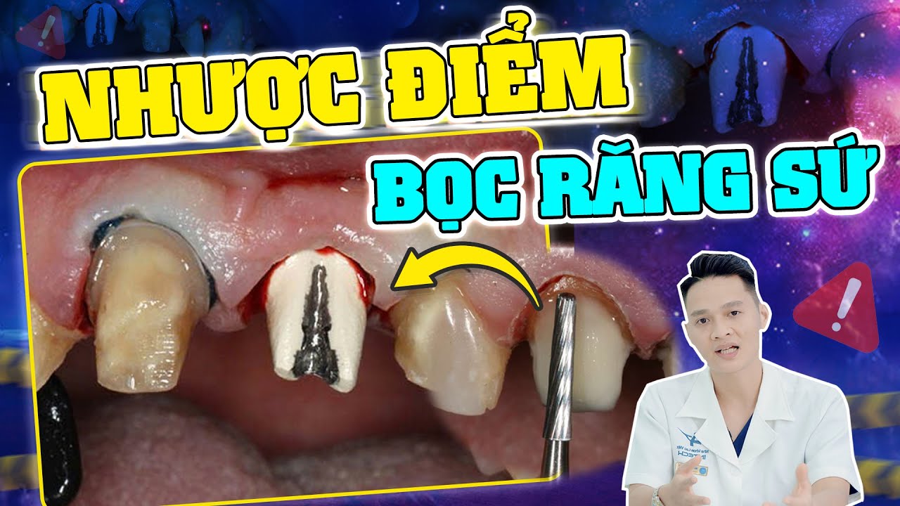 Nhược điểm của bọc răng sứ: Đọc kĩ để tránh hối hận sau khi làm