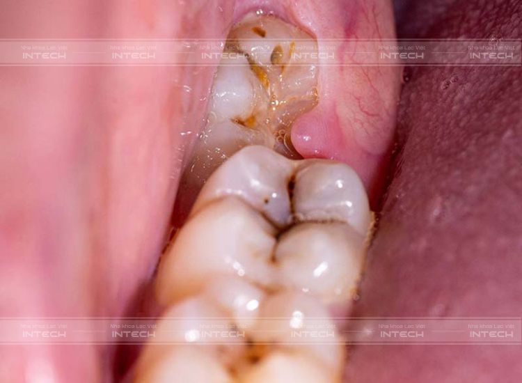 Áp xe được hình thành do răng khôn bị nhiễm trùng