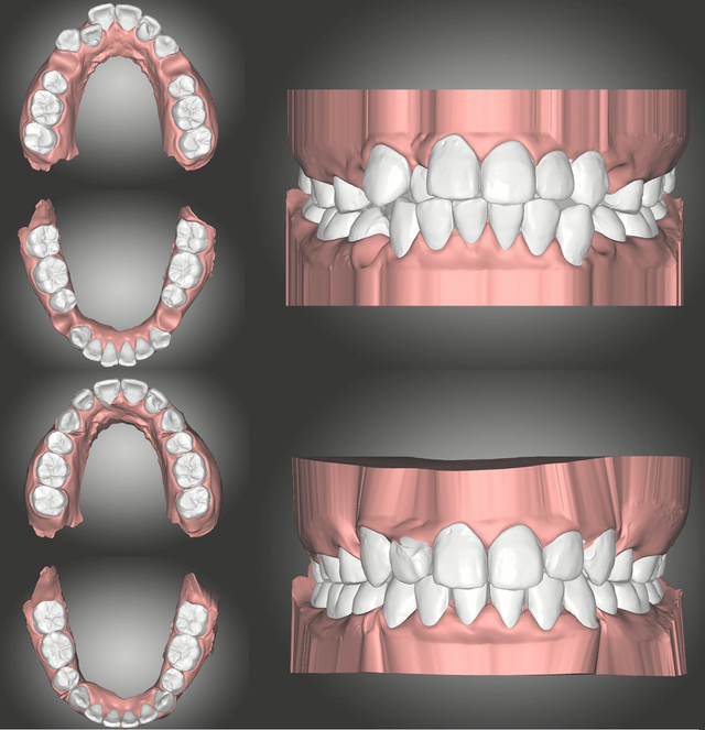 AutoLign cho phép biết trước kết quả trước và sau khi niềng răng