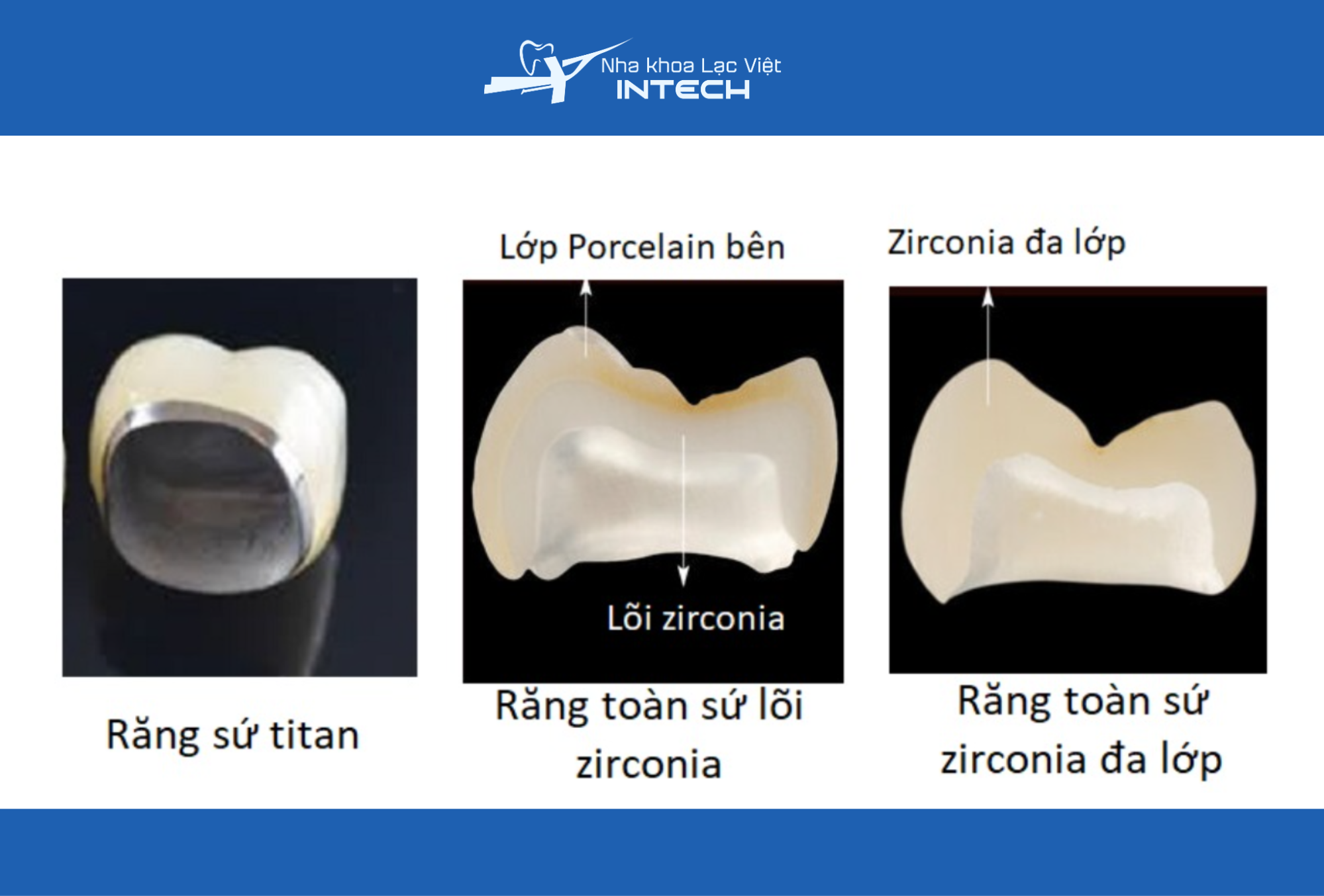 Ba dòng răng sứ gắn trên Implant bao gồm răng sứ titan, răng sứ toàn lõi Zirconia và răng sứ Zirconia đa lớp 