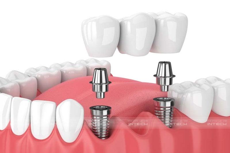 Phương pháp trồng răng bắc cầu Implant không cần phải mài răng bên cạnh