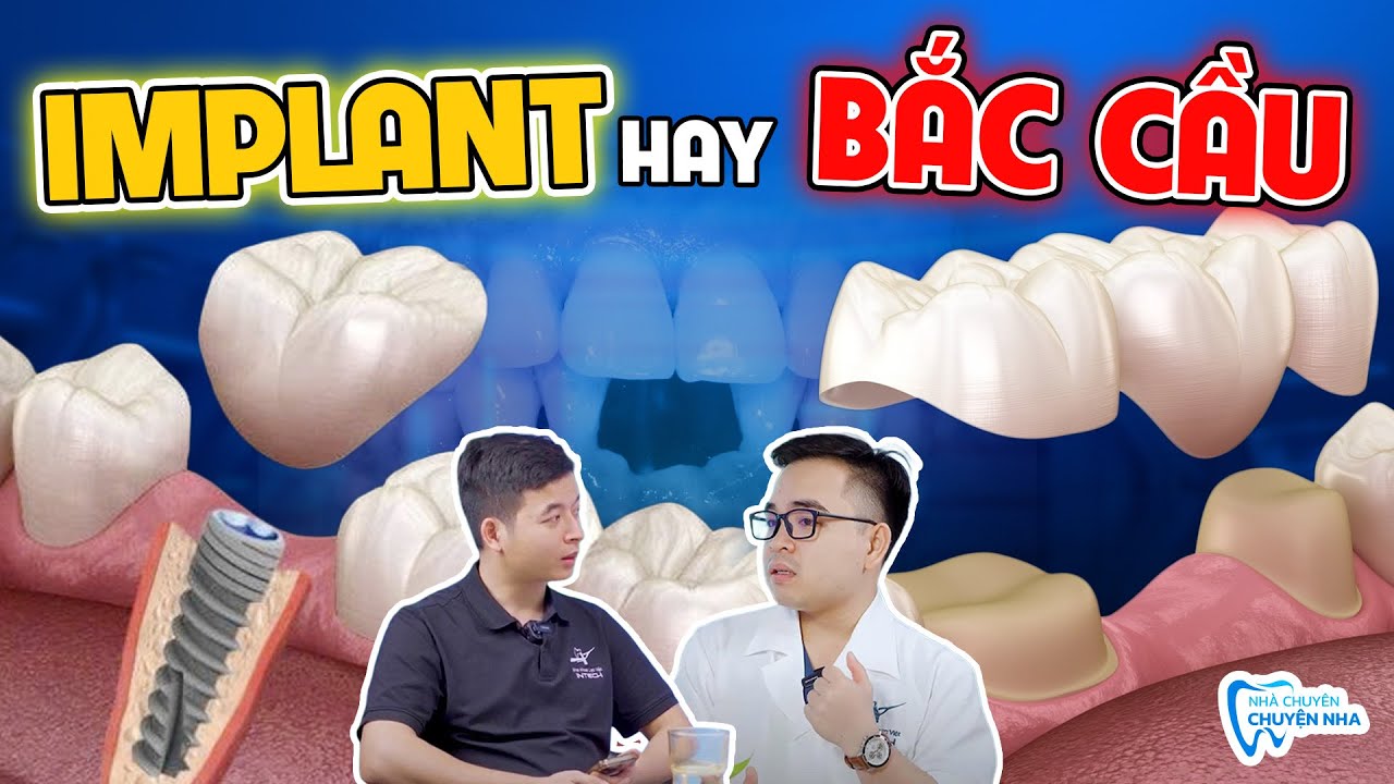 Nên Làm Răng Bắc Cầu Hay Implant? Nhiều Người Hối Hận Vì Cầu Răng Sau 5 Năm Sử Dụng!