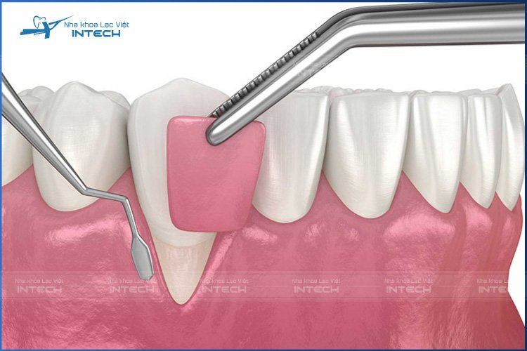 Bác sĩ có thể chỉ định ghép lợi cho người bị tụt lợi do mất răng lâu năm để cải thiện thẩm mỹ, tạo lớp bảo vệ răng Implant