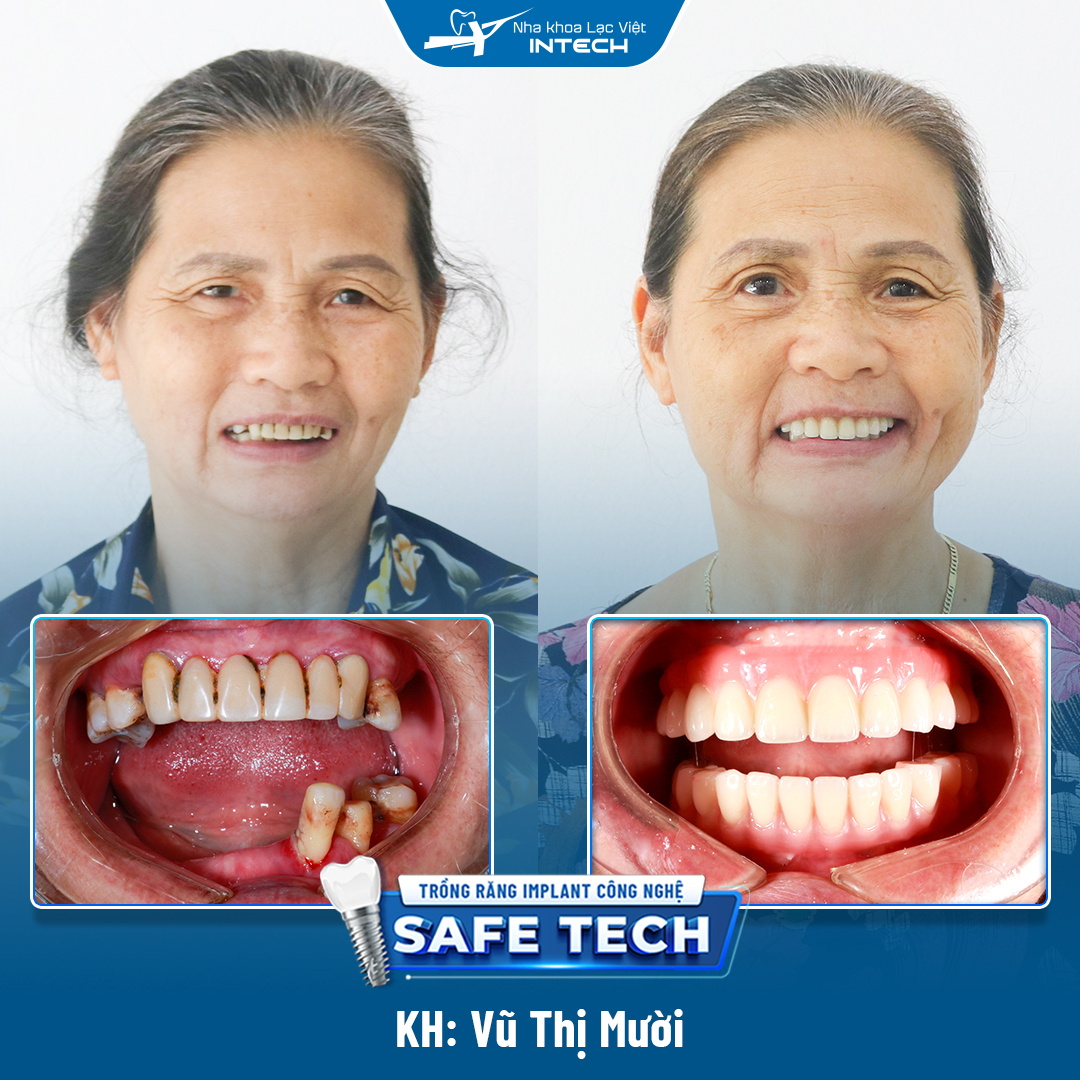Sau khi trồng răng implant, cô Vũ Thị Mười cảm thấy mình trẻ hơn và đặc biệt là ăn nhai rất tốt