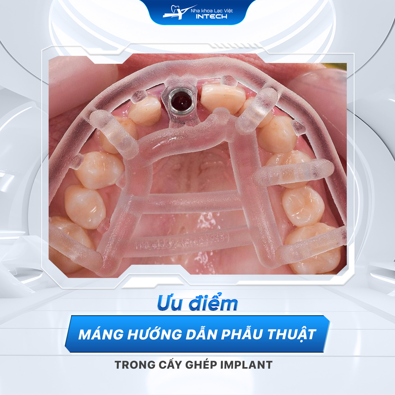 Bác sĩ thực hiện quá trình đặt trụ Implant bằng máng hướng dẫn phẫu thuật Guideline giúp tăng độ chính xác