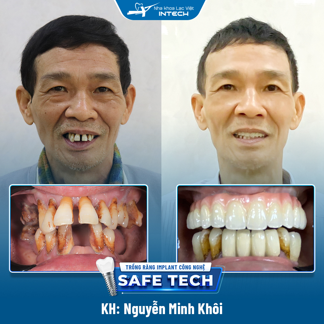 Chú Nguyễn Minh Khôi - Khách hàng trồng răng thành công bởi bác sĩ Vương