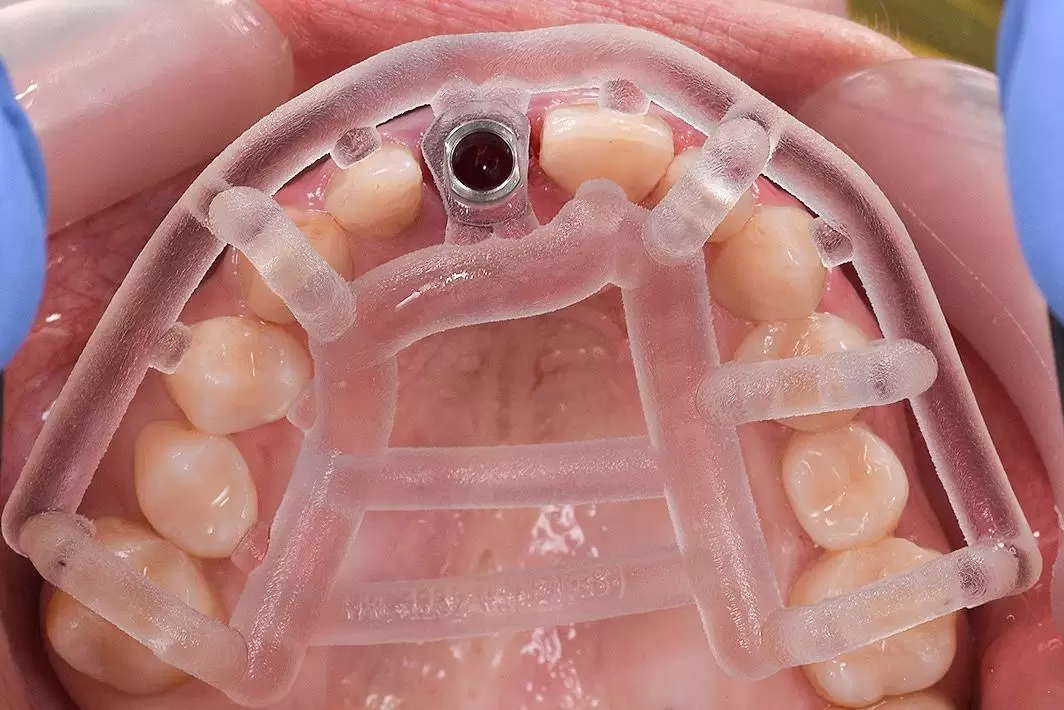 Sử dụng máng hướng dẫn phẫu thuật để đặt trụ đúng trục sinh học và chuẩn xác, tránh nguy cơ mất tích hợp trụ implant