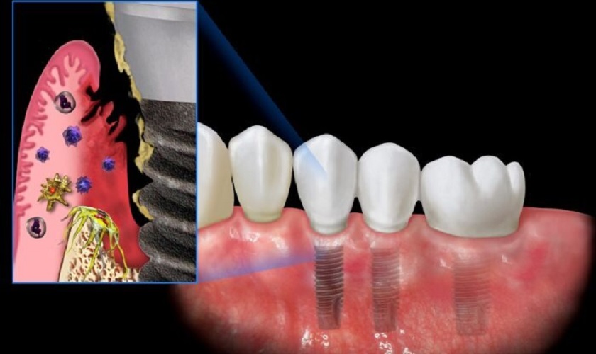 người bị tiểu đường cấy implant dễ bị nhiễm trùng