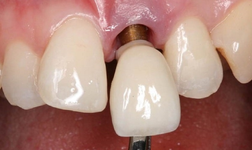 bệnh nhân đang xạ trị không nên trồng implant