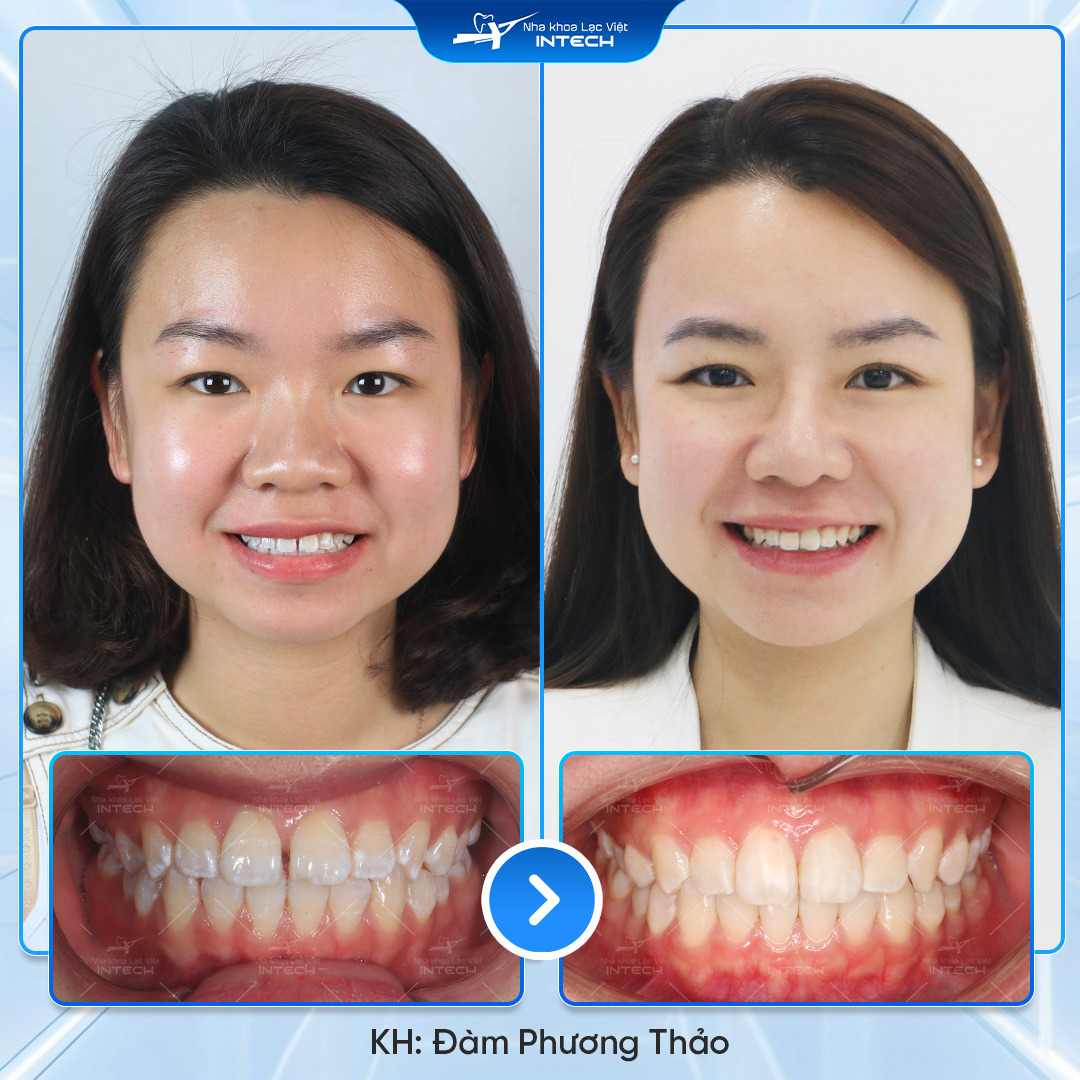 Khách hàng Đàm Phương Thảo niềng răng tại Lạc Việt Intech
