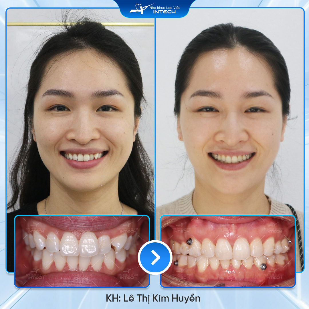 Khách hàng Lê Thị Kim Huyền niềng răng tại Lạc Việt Intech