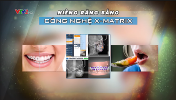 X-MATRIX - Công nghệ niềng răng vượt trội so với các công nghệ khác