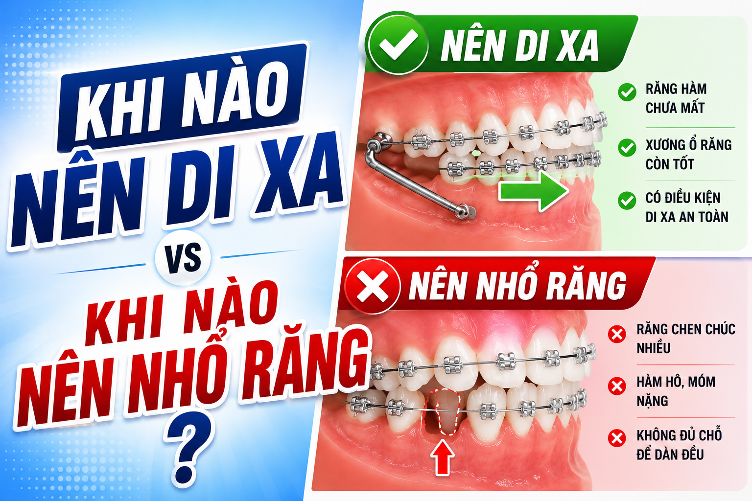 Hô do răng răng điều trị như thế nào? Bác sĩ dựa vào gì để chọn IPR, di xa hay nhổ răng