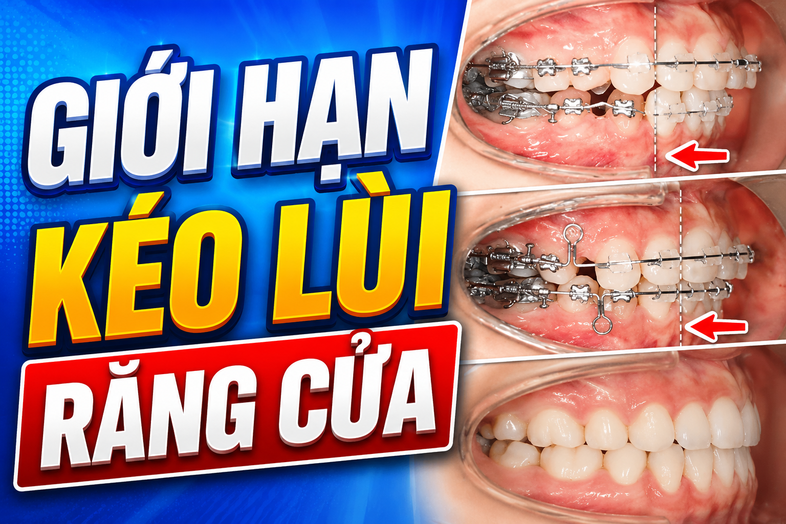 Giới hạn kéo lùi răng cửa: khi nào cần lo về an toàn xương ổ răng và môi?