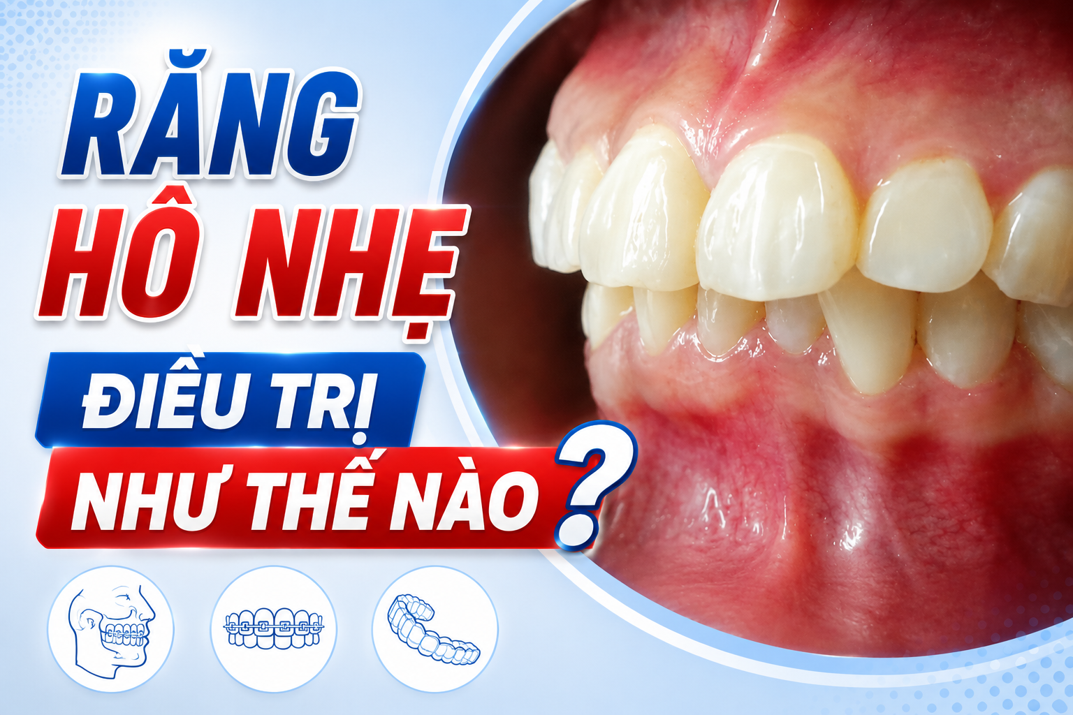 Hô nhẹ điều trị như thế nào? Khi nào dùng IPR, khi nào di xa, khi nào nong hàm 
