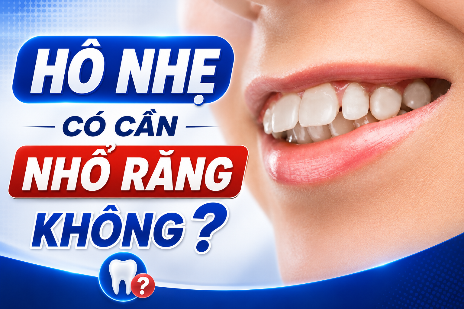 Hô nhẹ có cần nhổ răng không? Khi nào phải nhổ và khi nào có thể bảo tồn