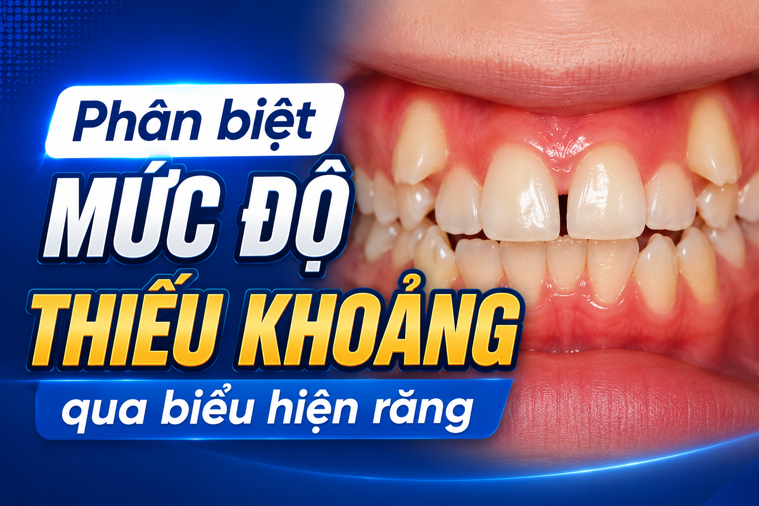 Hô kèm chen chúc: phân biệt mức độ thiếu khoảng qua biểu hiện răng 