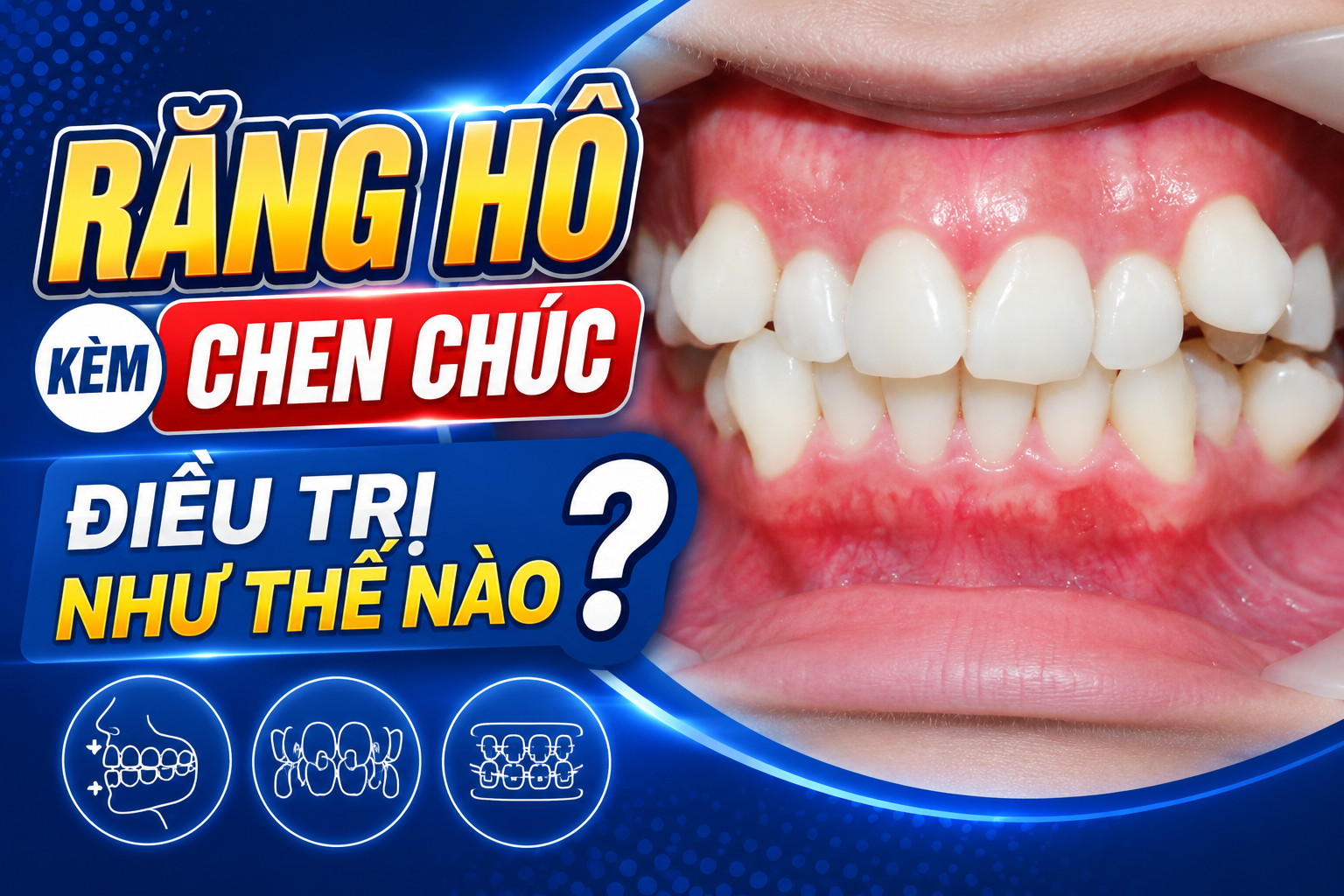 Răng hô kèm chen chúc điều trị như thế nào?