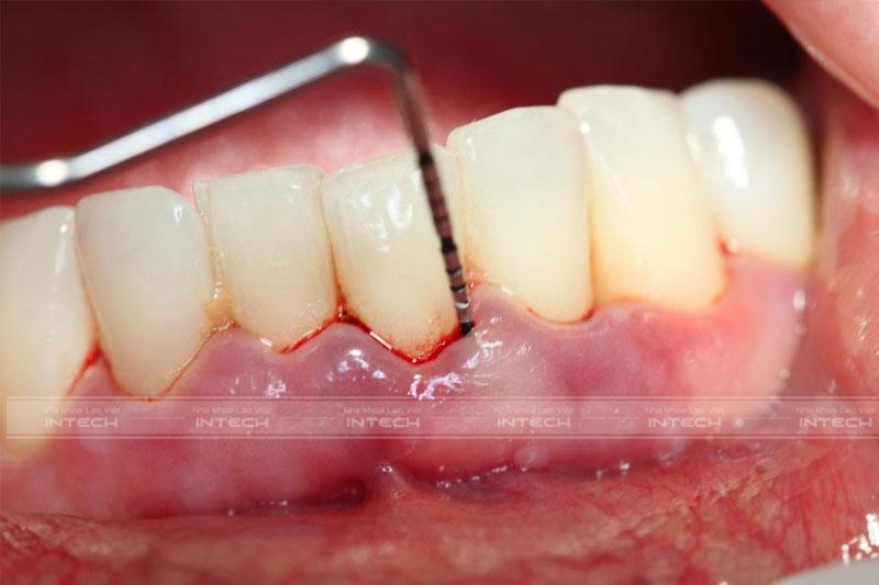 Người đang bị bệnh lý răng miệng như viêm nha chu không được cấy Implant