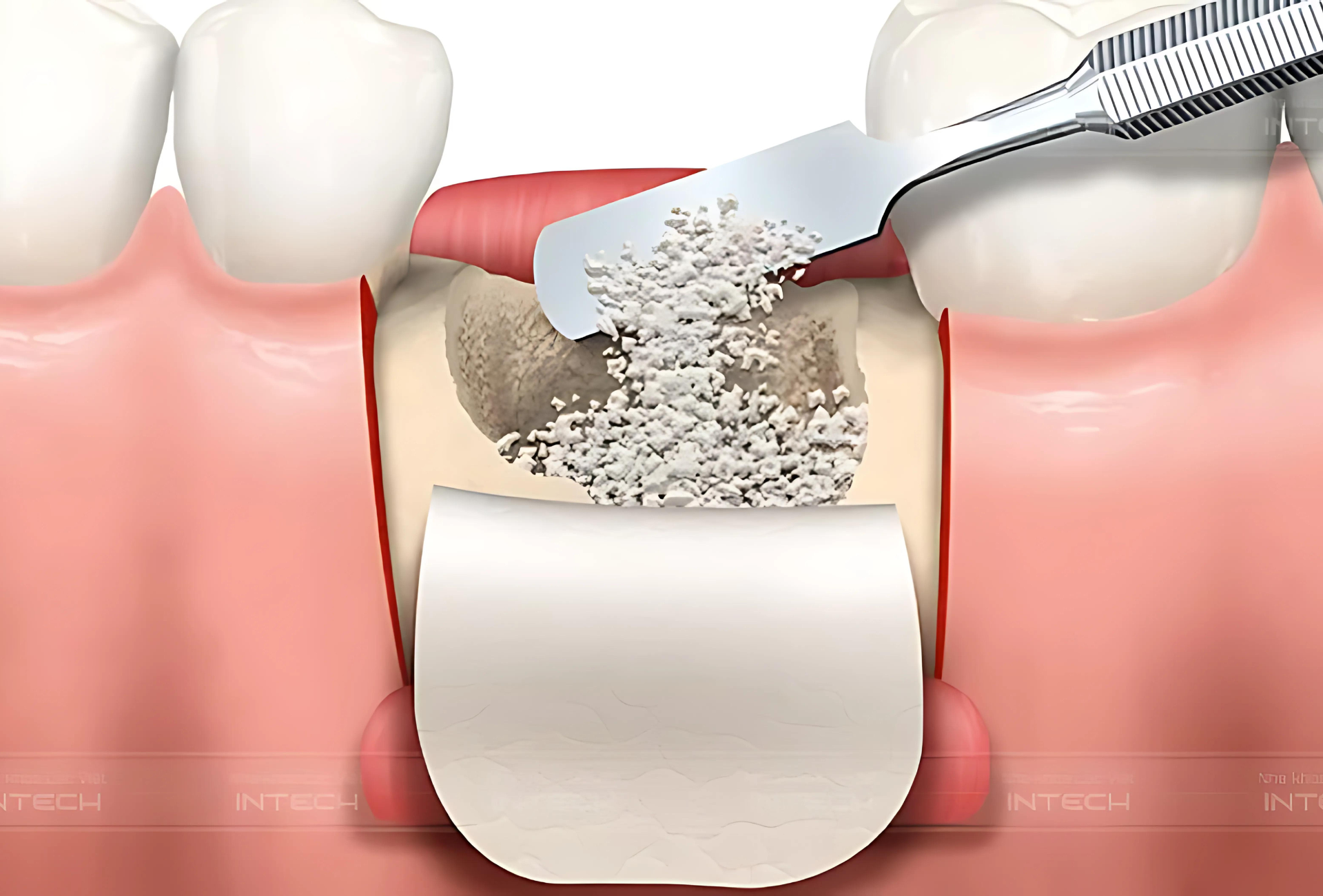 Trong trường hợp mật độ xương không đủ, bệnh nhân có thể thực hiện ghép xương trước khi tiến hành trồng răng Implant