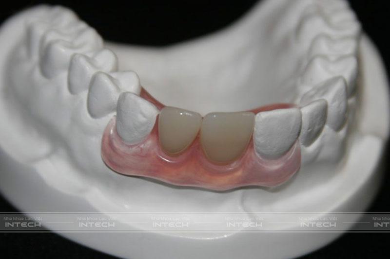 Trường hợp bệnh nhân bị mất răng cửa và làm hàm giả có thể niềng răng kết hợp cấy Implant khôi phục răng mất