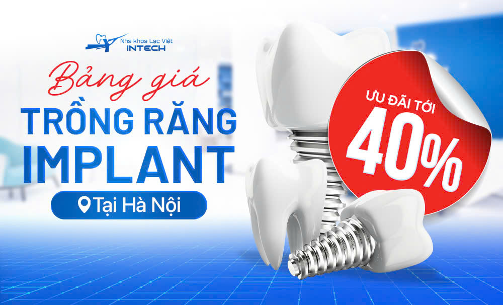 CHƯƠNG TRÌNH KHUYẾN MÃI ĐẶC BIỆT TẠI HÀ NỘI – GIẢM ĐẾN 40% CHI PHÍ TRỒNG RĂNG IMPLANT