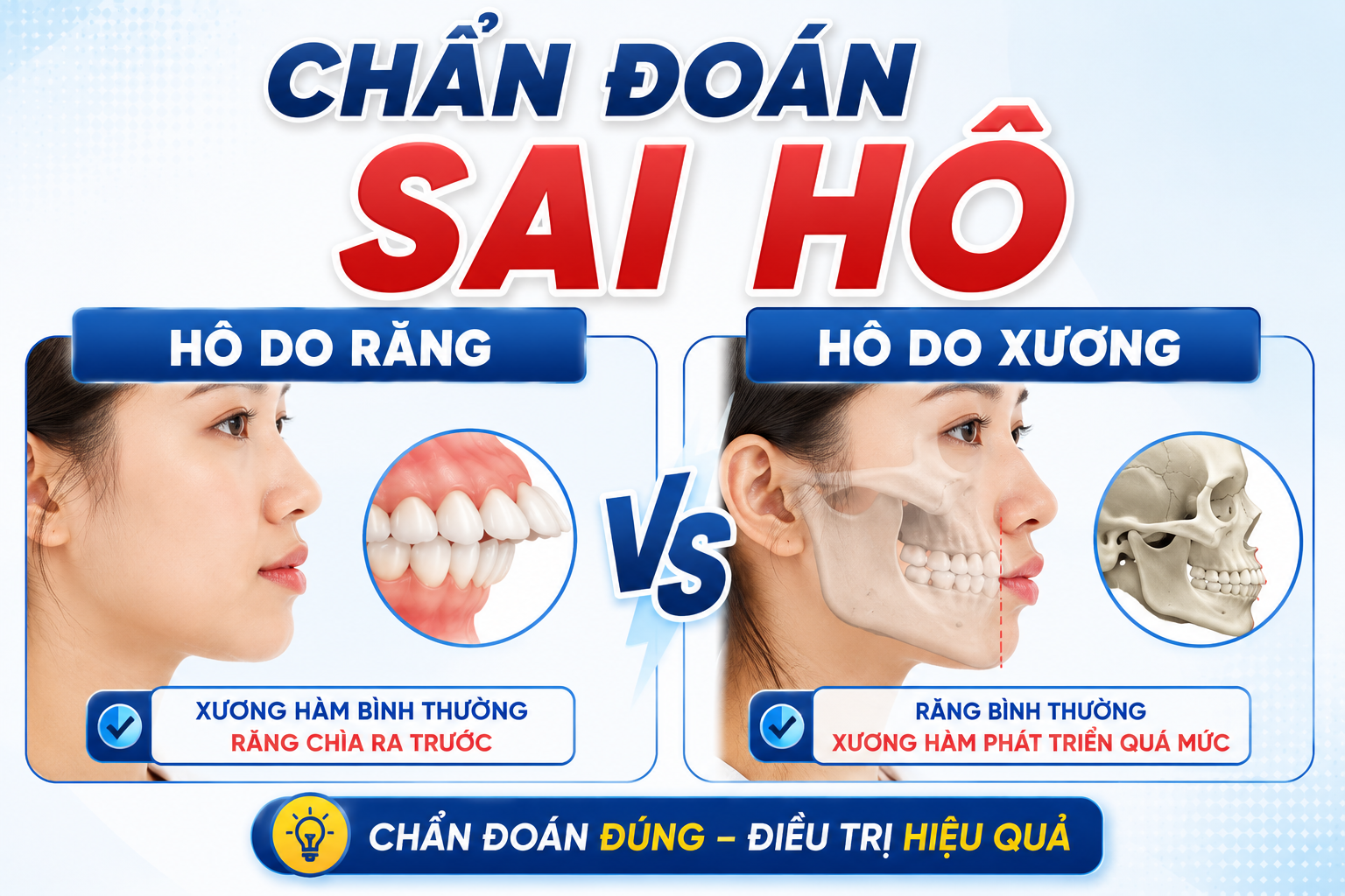 Chẩn đoán sai hô do răng và hô do xương: Dễ điều trị sai hướng và sai kỳ vọng khi niềng răng
