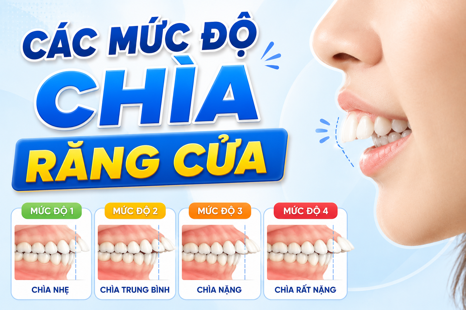 Răng cửa trên chìa mức nào thì được xem là hô rõ?