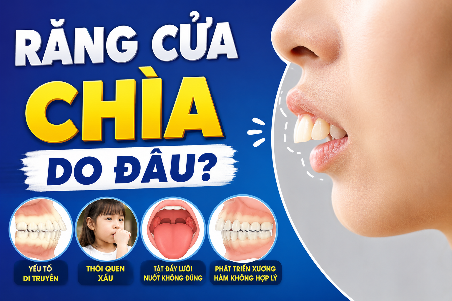 Răng cửa chìa do đâu? Các nguyên nhân phổ biến gây ra tình trạng chìa răng cửa