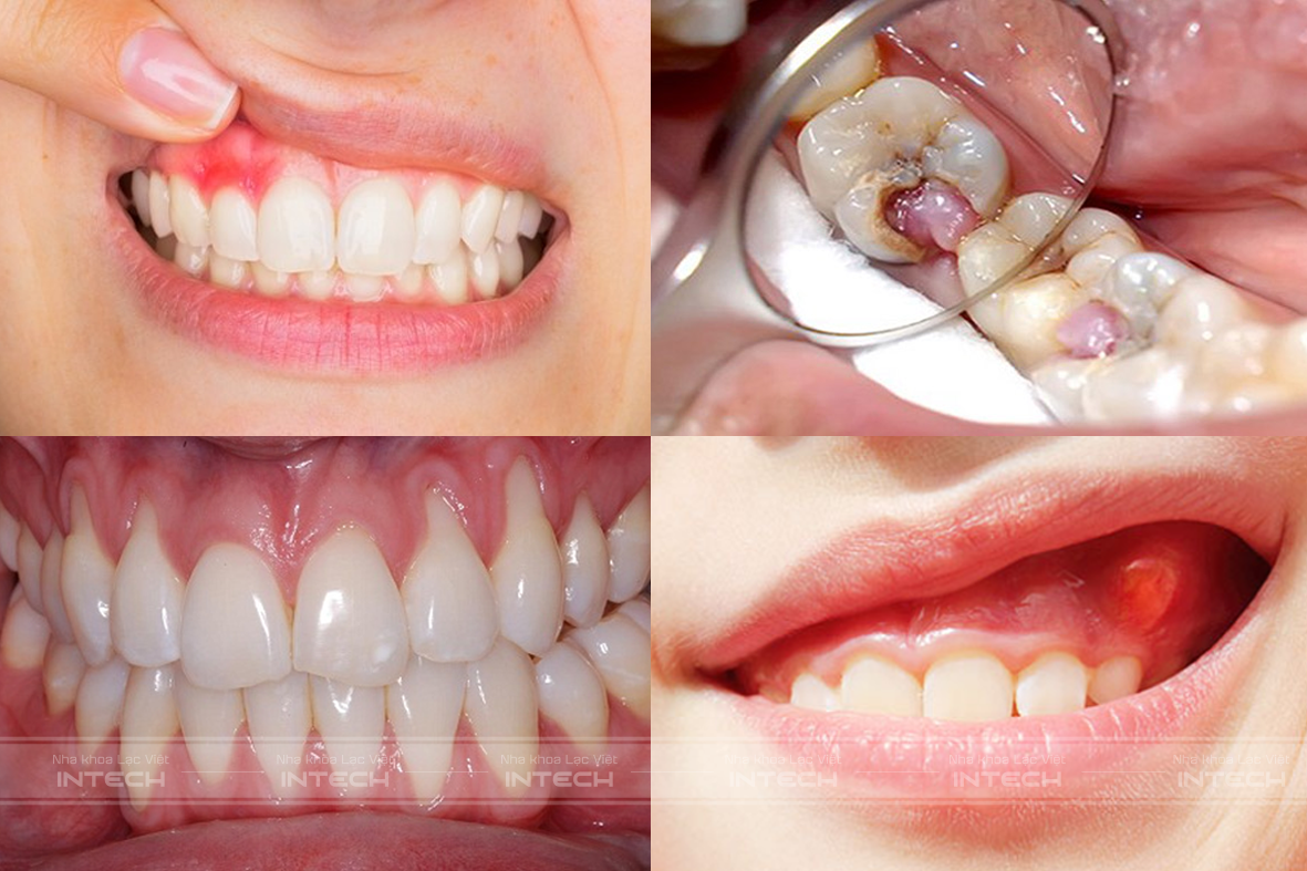 Những biến chứng ảnh hưởng đến sức khỏe răng miệng khi nắn chỉnh răng tại nhà