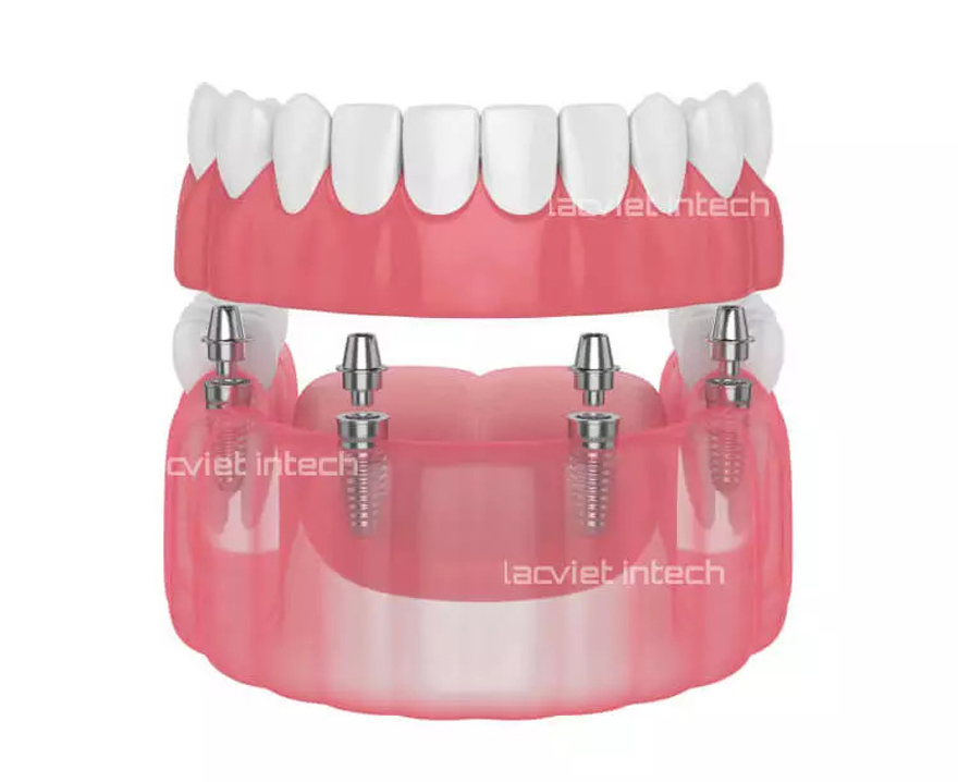 Biểu tượng kỹ thuật cấy ghép implant All – on – 4