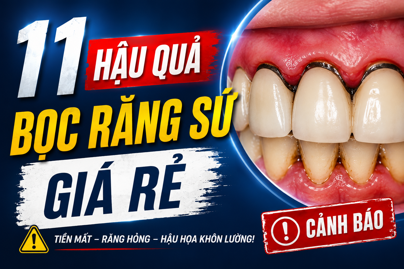11 Hậu Quả Bọc Răng Sứ Giá Rẻ Khách Hàng Nhất Định Phải Biết 