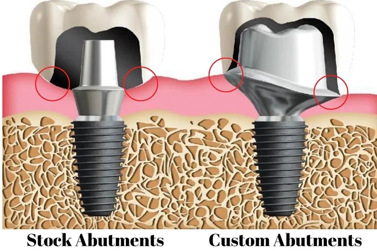 Giải pháp Trồng Răng Implant DCT  – Sự Lựa Chọn Hoàn Hảo Cho Sức Khỏe Răng Miệng Và Nụ Cười Của Bạn