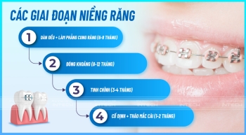 CÁC GIAI ĐOẠN NIỀNG RĂNG CHI TIẾT NHẤT BẠN NÊN BIẾT