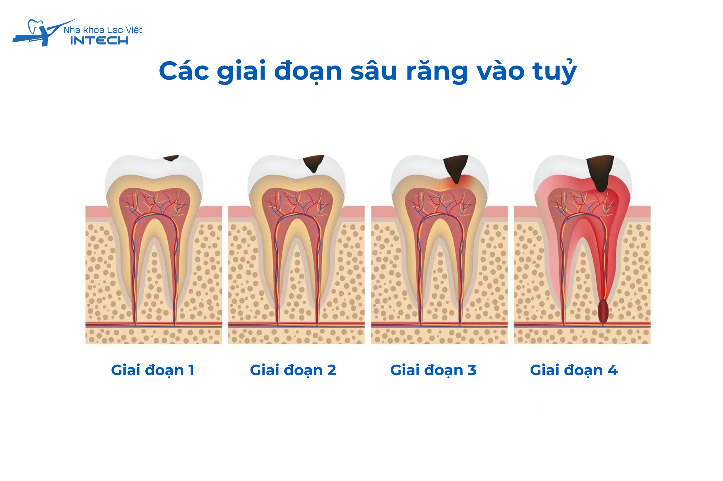 Các giai đoạn khi sâu răng vào tuỷ