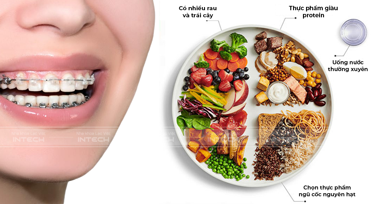 Nên có chế độ ăn uống khoa học khi thực hiện niềng răng
